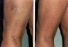 typisk misfarging av hud - før og etter thumbnail